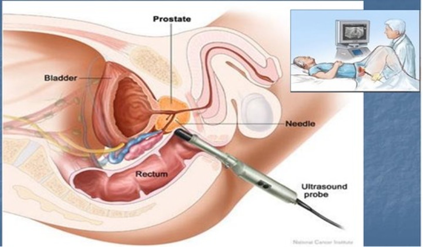 <p>ultrasound procedure used to diagnose prostate cancer. Sound waves are sent and recieved by a transducer probe that is placed into the rectum</p>
