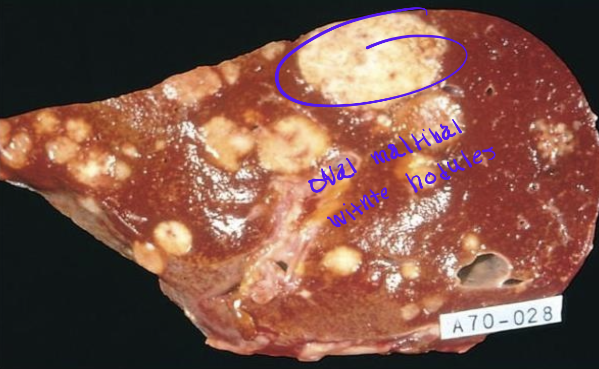 <p>Identify the <strong>organ</strong> and the <strong>diagnosis</strong> in this format: <em>diagnosis, organ</em></p>