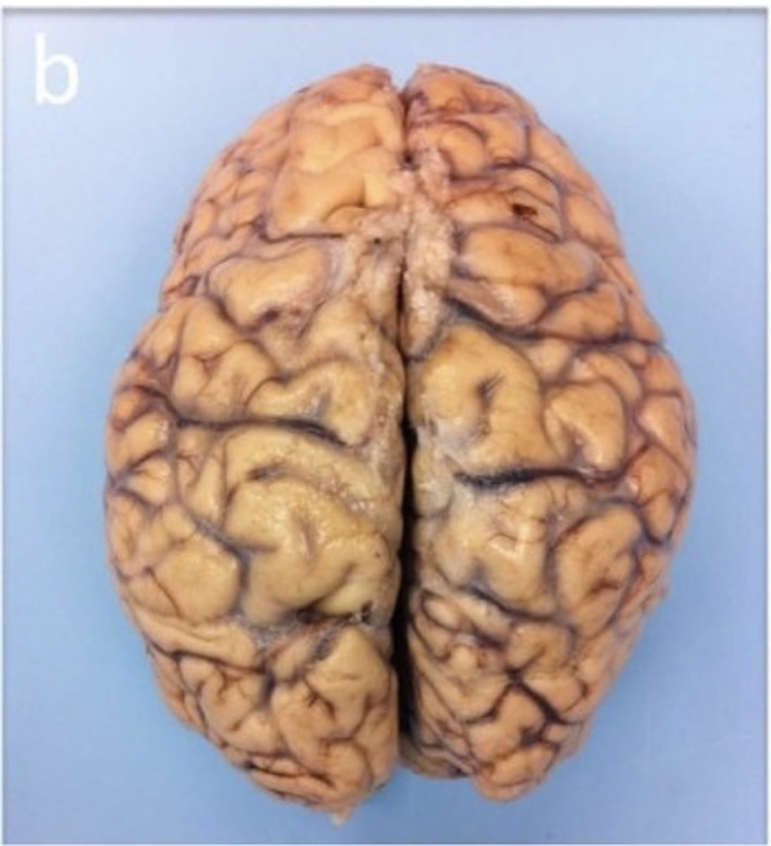 <p>1. Also known as posterior</p><p>2. Refers to the back of the anatomical structure</p>