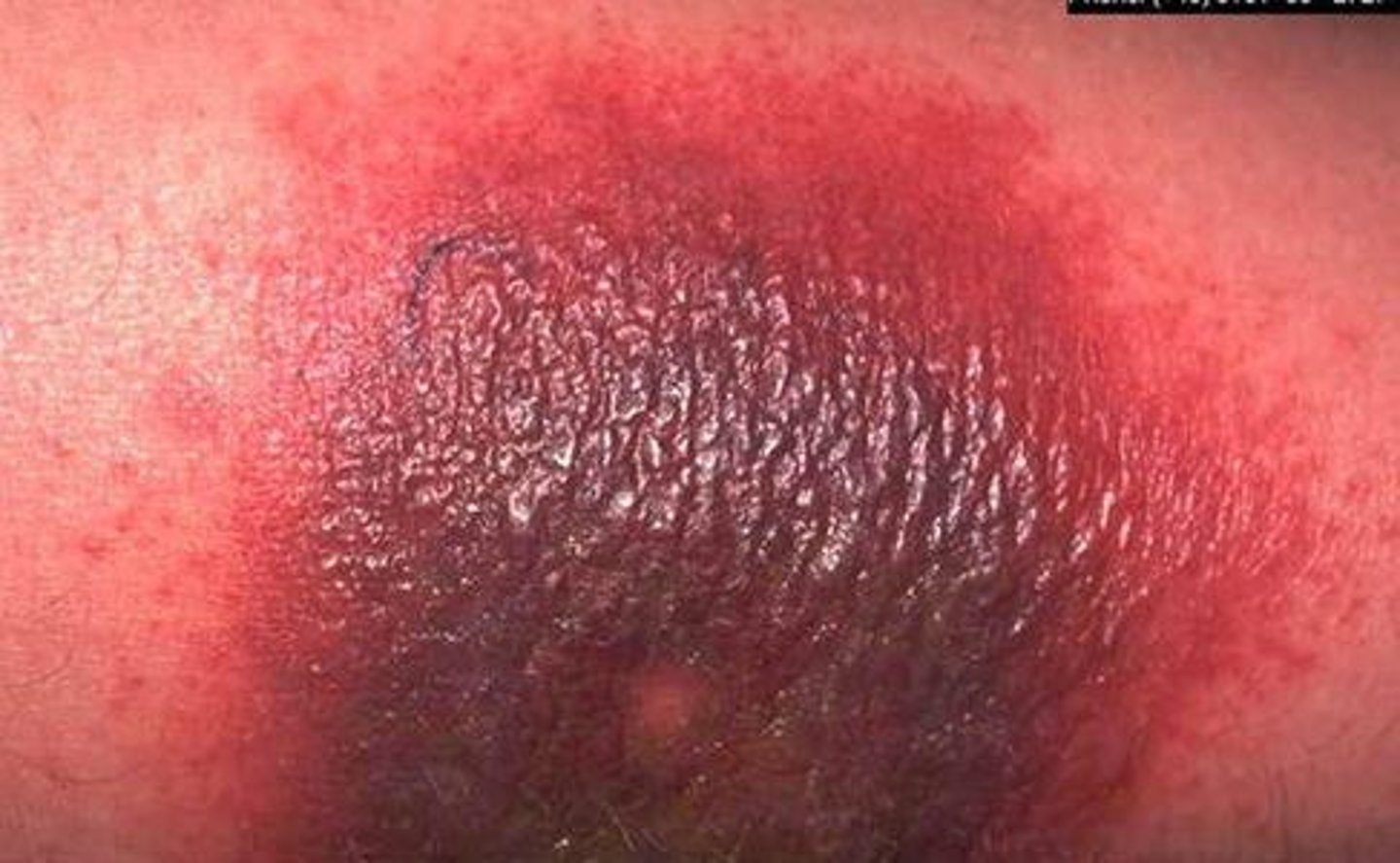 <p>acute immune complex vasculitis causes a localized area of tissue necrosis in the skin developing 4-10 hours after the injection</p>