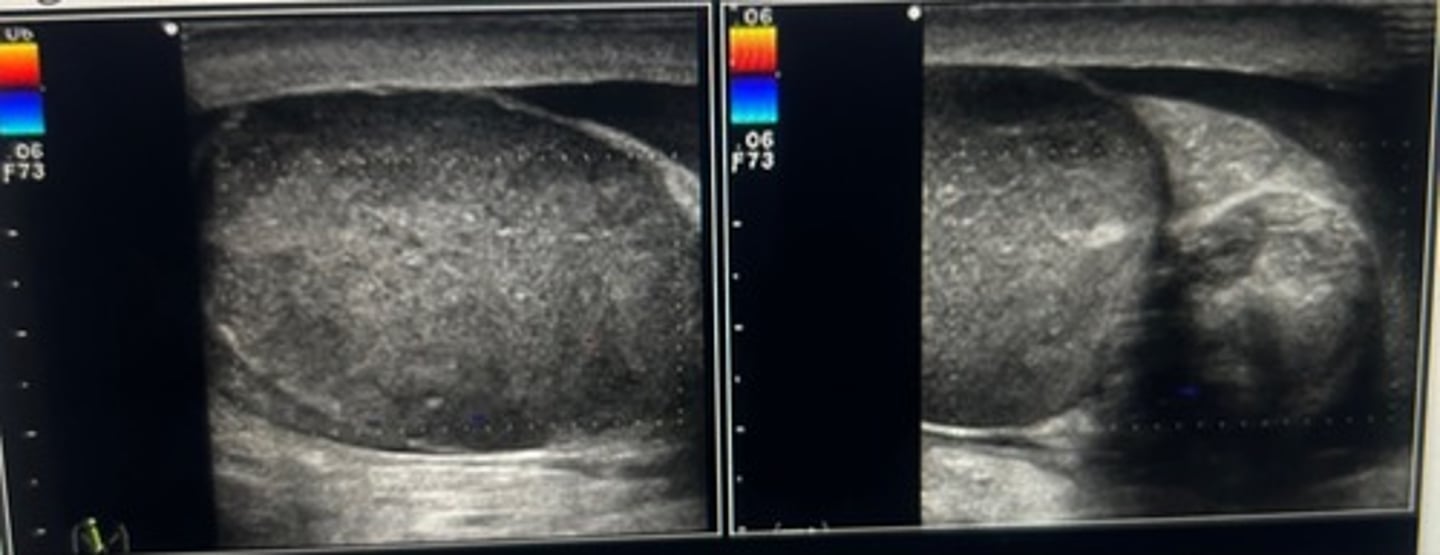 <p>The right testicle appears torsed</p><p>Note the body marker on the image indicates the right side. There's no colorful present for the right, testicle or epididymis, which indicates no blood flow is present. Note the overall heterogenicity of the testicle and epididymis. As ischemia sets in the tissue will become increasingly heterogeneous, recent, groin trauma can lead to torsion of the testicle within the scrotal sac.</p>