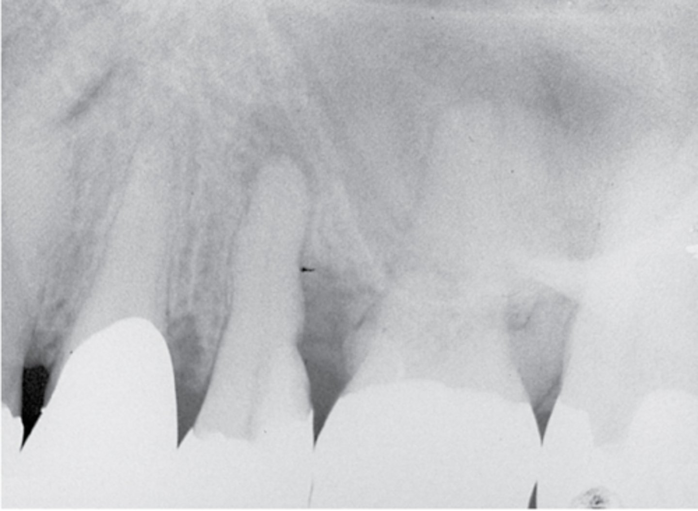 <p>What type of lesion?</p><p>- No response to cold</p><p>- No pain on percussion or palpation</p><p>- Distal bone loss and deep pocket (independent of the PARL)</p><p>- Pulpal dx: Necrotic pulp</p><p>- Periapical dx: Asymptomatic apical periodontitis</p>