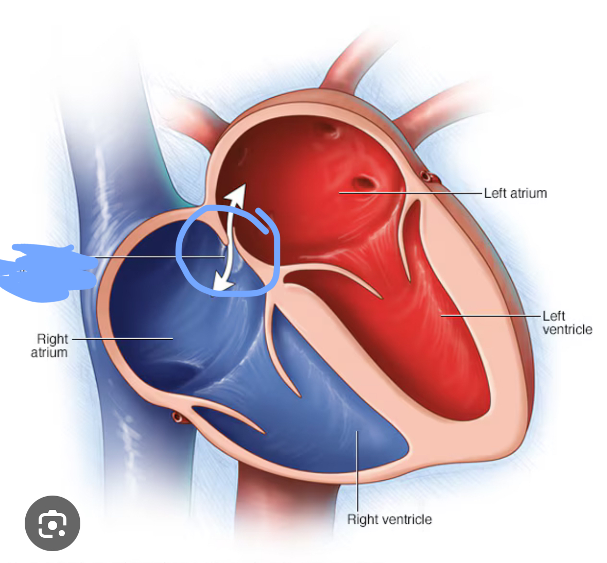 <p>Small opening in the interatrial septum. Present in fetuses</p>