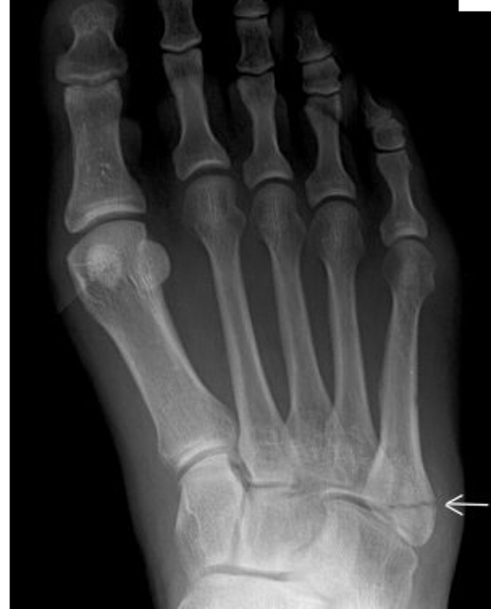 <p><strong>______________</strong> – base of 5th metatarsal</p>