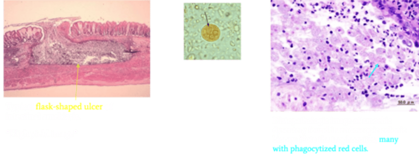 <p>Identify Pathogen causing Diarrhea:</p><p>Amebiasis/Amebic dysentery</p><p>-Hx:</p><p>&gt; Mainly in developing countries</p><p>-Path: Cysts are ingested, resist acid in the stomach, excyst to the trophozoite form in the colon, and then invade the epithelium, leading to ulceration --&gt; Form trophozoites in small intestine and invade tissue</p><p>-Sx/PE:</p><p>&gt; BLOODY Diarrhea (dysentery)</p><p>&gt; Ascends portal system ==&gt; Liver Abscess</p><p>&gt;&gt; RUQ Pain</p><p>&gt;&gt; "Anchovy paste" exudate in abscess</p><p>-Dx:</p><p>&gt; Smear = Trophozoites</p><p>&gt; ELISA = Fecal Antigen</p><p>&gt; Histology:</p><p>&gt;&gt; Typical flask-shaped ulcer of intestinal amebiasis</p><p>&gt;&gt; Many trophozoites w/ phagocytized red cells</p>