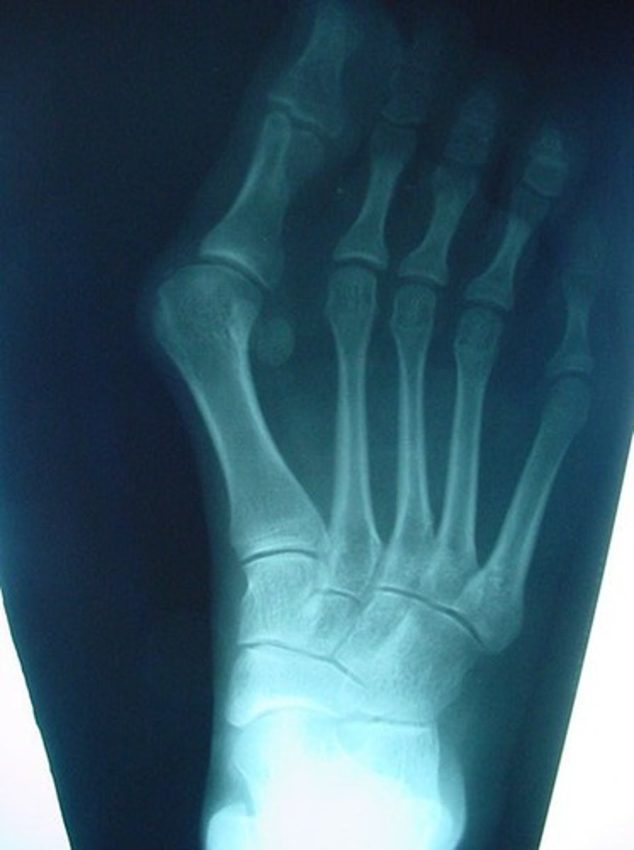<p><strong>__________</strong> – Hallux Valgus</p>