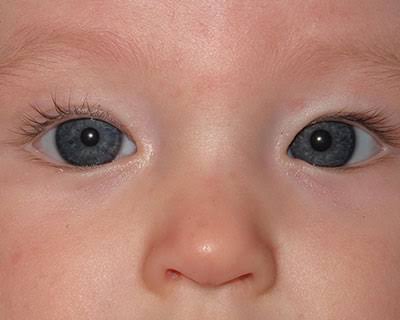 <p></p><p>Normal in young children, the pupils will appear at the inner canthus (due to the epicanthic fold).</p>