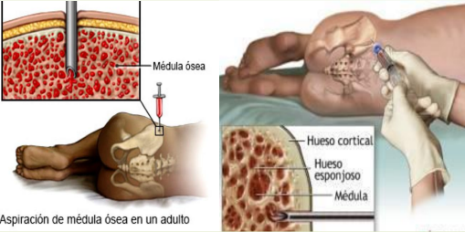 <p><strong>Citologico</strong>: Aspiración de células, saca liquido con celulas</p><p><strong>Biopsia</strong>: saca un trocito de medula</p><p>En espina iliaca postero superior o esternon (cresta iliaca)</p><p>Resultado anormal: Aplasia, tumores, etc</p>