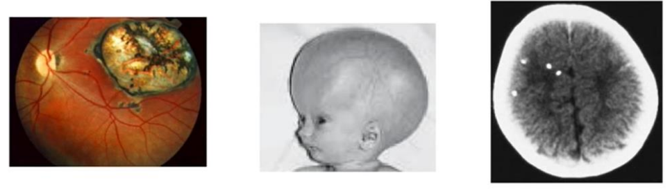 <ol><li><p>Chorioretinitis</p></li></ol><ol start="2"><li><p>Hydrocephalus</p></li><li><p>Intracranial calcifications</p></li></ol><p></p>