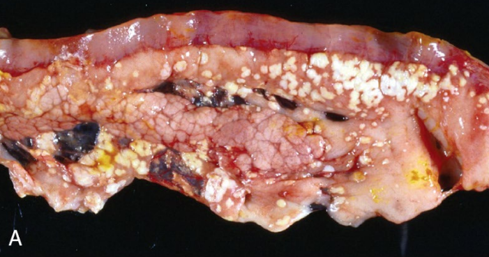 <p>Tissues from a 5-year-old, spayed female dog. Clinical history: The dog ate a pound of butter and an entire rhubarb pie. Morphological diagnosis? Two possible long-term sequelae (if chronic and recurrent)</p>