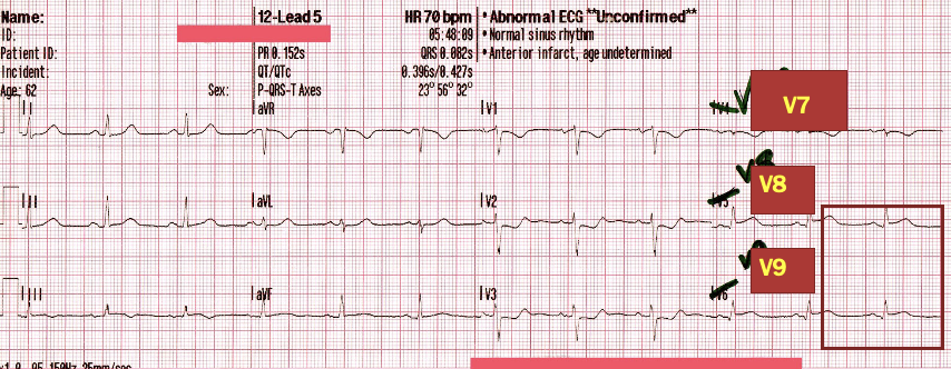 <p>ST depression in leads V1-4 w/ ST elevation in leads V7-V9</p>