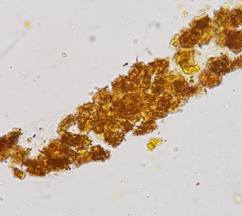 <p>RTE reabsorbed bilirubin from glomerular filtrate and sloughed off into urine</p>