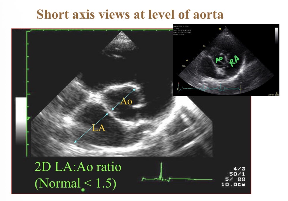 <p>Normal LA: Ao diameter </p>