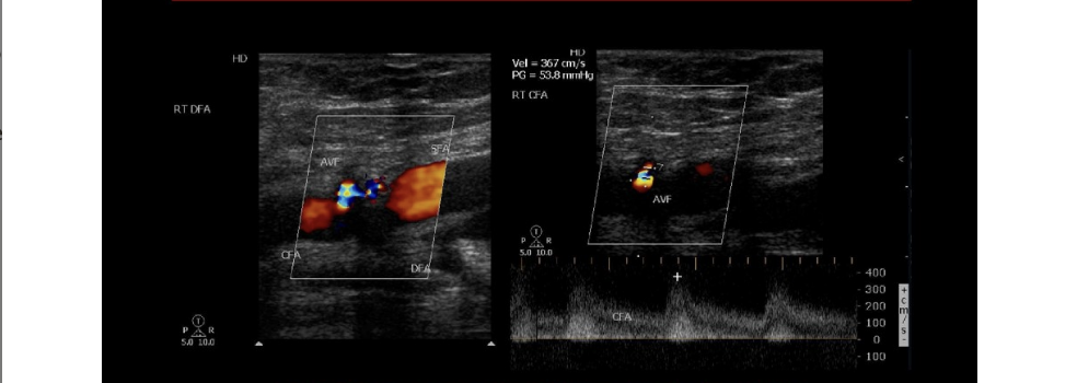 <p>An AV fistula connects the femoral artery + vein at right groin. the doppler evaluation of the common femoral artery will show what pattern</p><p>.</p><p>a) biphasic flow w/increased diastolic flow </p><p>b) monophasic w/minimal diastolic flow </p><p>c) peak, triphasic waveform </p><p>d) monophasic w/increased diastolic </p>