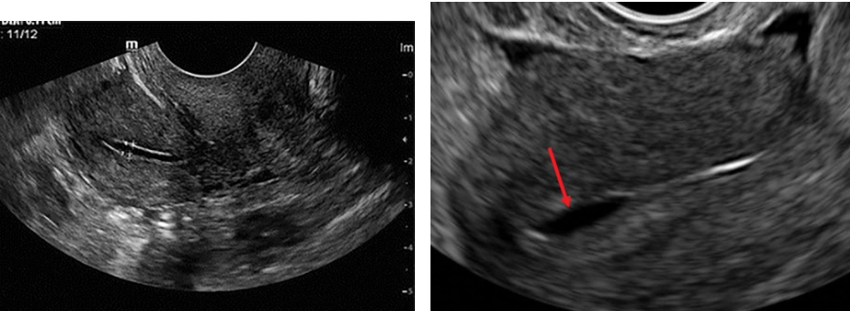 <p><strong><em>____________________also occur with ectopic pregnancy,</em></strong></p><p class="p1"><strong><em>endometritis, degenerating myomas, and recent abortion.</em></strong></p><p class="p1"> Sonographic Findings: Transvaginal sonography, with its improved resolution,</p><p class="p1">sometimes shows tiny endometrial fluid collections not seen on transabdominal</p><p class="p1">scans.</p><p class="p1"> ………………………. (less than 2 mL) are <strong>common in women</strong></p><p class="p1"><strong>during the menstrual phase of the cycle.</strong> They are seen in <strong>postmenopausal</strong></p><p class="p1"><strong>women, especially during the menstrual phase in women taking sequential</strong></p><p class="p1"><strong>hormones.</strong></p><p class="p1"> <em>In a uterus with a fluid collection, the anteroposterior diameter of the fluid should be</em></p><p class="p1"><em>subtracted from the endometrial measurement for a true assessment of endometrial</em></p><p class="p1"><em>thickness.</em></p>