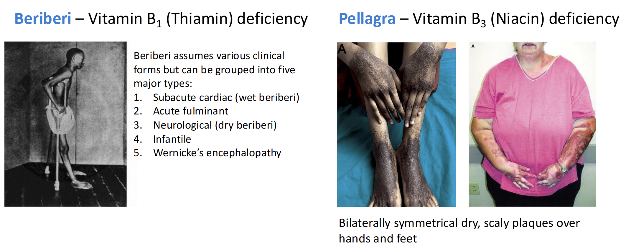 <p>Beriberi - vitamin B1(thiamin) deficient</p><p>Pellagra - vitamin B3 (Niacin) deficient</p>