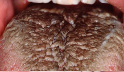 <p>excess keratin on surface of filiform papillae </p>