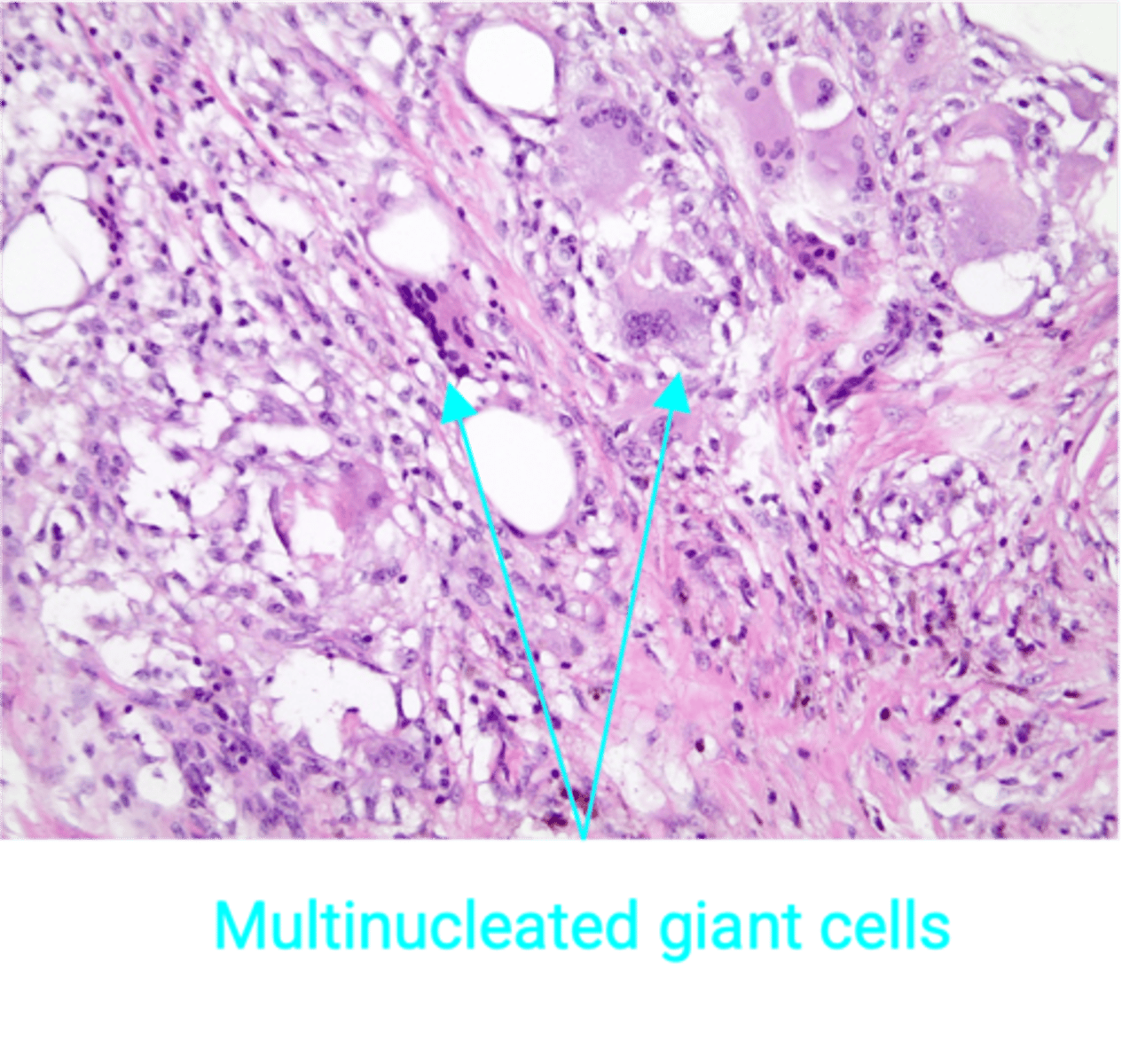 <p>Define Condition:</p><p>Necrosis of breast fat - benign, inflammatory process</p><p>-Hx: Usually related to trauma (sports injury, seatbelt injury)</p><p>-Sx/PE: Mass on physical exam</p><p>-Dx:</p><p>&gt; Mamm = Abnormal calcification (d/t saponification)</p><p>&gt; Histo = Necrotic fat with associated calcifications, histiocytes, and multinucleated giant cells</p>