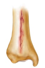 <p>fracture</p>