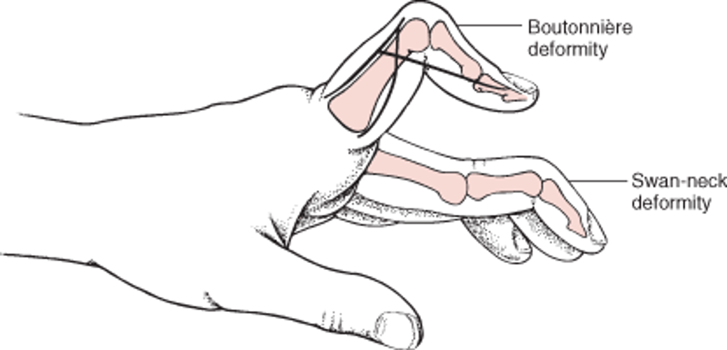<p>PIP hyperextension</p><p>DIP flexion</p><p>common in RA</p>