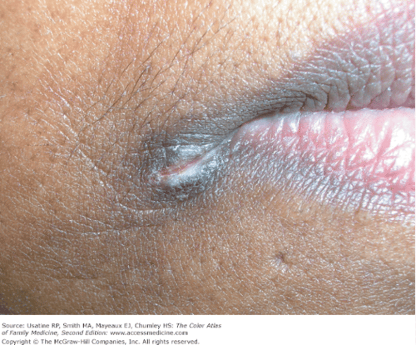 <p>A linear crack in the skin</p><p>- Ex: Angular cheilitis</p>