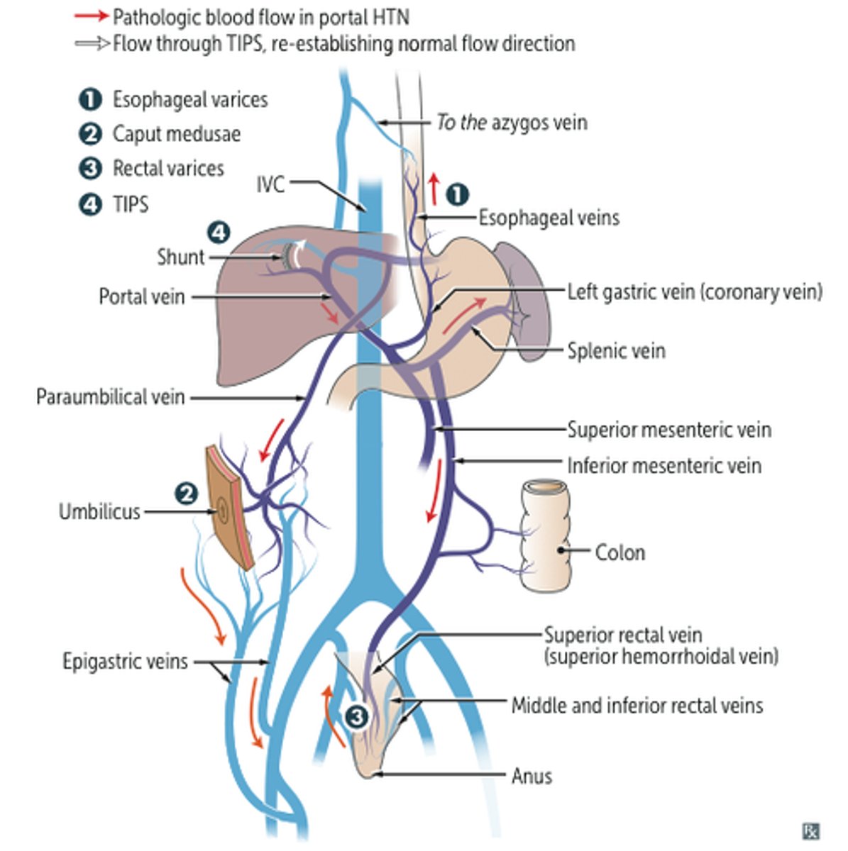 <p>in patients w/ elevated portal vein pressure (portal hypertension from cirrhosis) </p><p>• when the pressure in the portal vein is elevated, venomous enlargement (varies) tends to occur at and around the sites of portosystemic anastomoses </p>