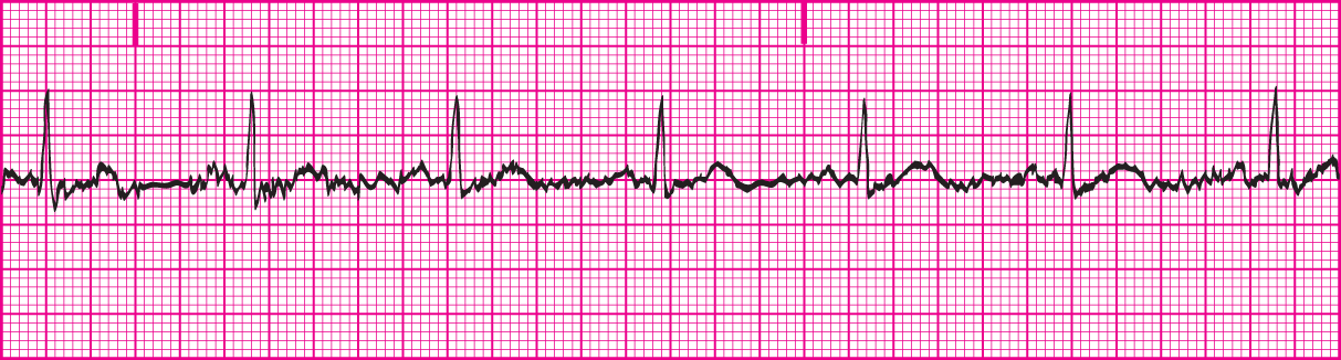 <p>Voluntary or involuntary muscle movement; also known as a body tremor. Movement of muscle is controlled by electrical voltages. These voltages appear as small erratic spikes on the ECG tracings. </p>