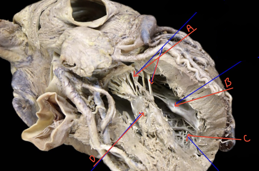 Left ventricle internal left superolateral 