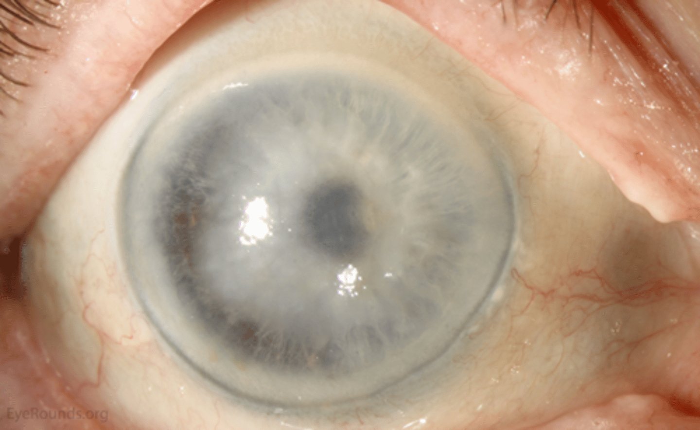 <p>What indication for corneal transplant is seen here?</p>
