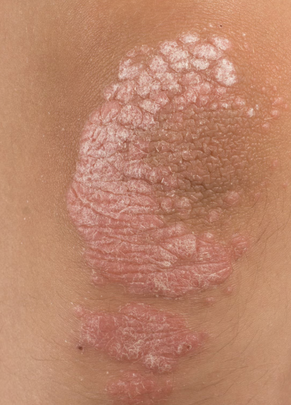<p>what type of raised, primary skin lesion is this?</p>
