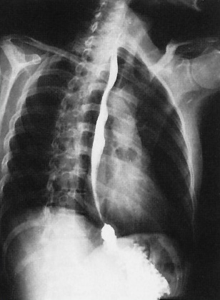 <p>What is this x-ray demonstrating?</p>