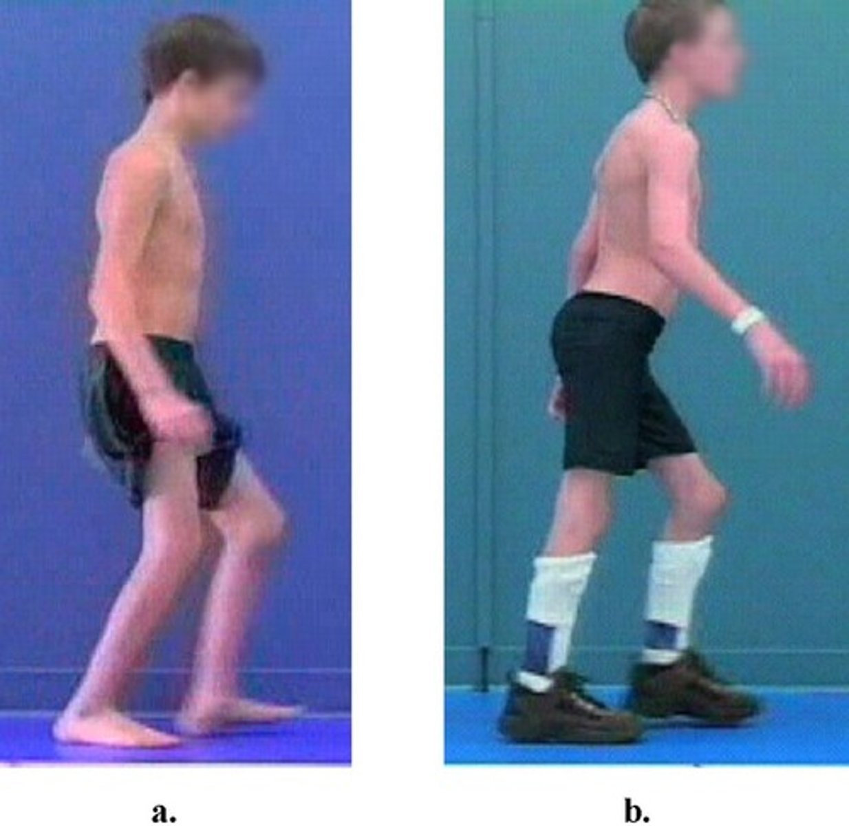 <p>muscular involvement</p><p>weakness - difficulty with hip extension, less control of leg in swinging forward</p><p>tightness- results in inability to fully extend the knee when the hip is flexed, associated with posterior tilting of the pelvis, in extreme cases results in a crouched gait</p>