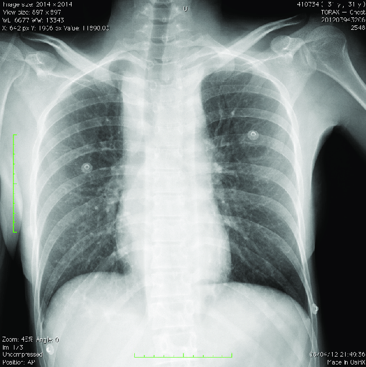 <p>CIR - alguns sinais da rotura traumática de aorta</p>