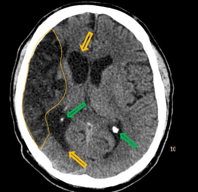 <p>Patient history: elderly patient with chronic symptoms such as severe, left spastic hemiparesis with hemihypesthesia </p><p>Modality: Non-enhanced CT, brain window setting (window level: 40 HU; window width: 80 HU) </p><p>Region: brain, axial view </p><p>Radiologic sign: Extensive hypodense (20-25 HU) brain parenchyma, concomitant dilatation of the right lateral ventricle (yellow arrows) due to brain tissue loss; calcifications of the choroideal plexuses (common finding, green arrows) </p><p>Diagnosis: chronic ischemic lesion in the territory of right MCA</p><p></p>
