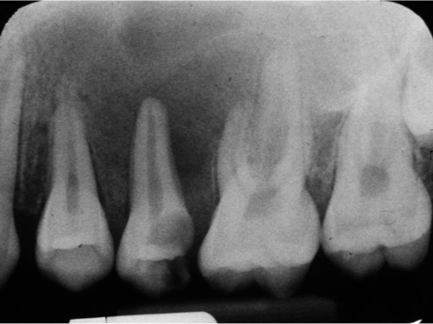 <p>This 14-year-old female came to the emergency clinic complaining of pain and swelling in her maxilla. The swelling was firm to the touch.</p><p>How would you evaluate the patient?</p>