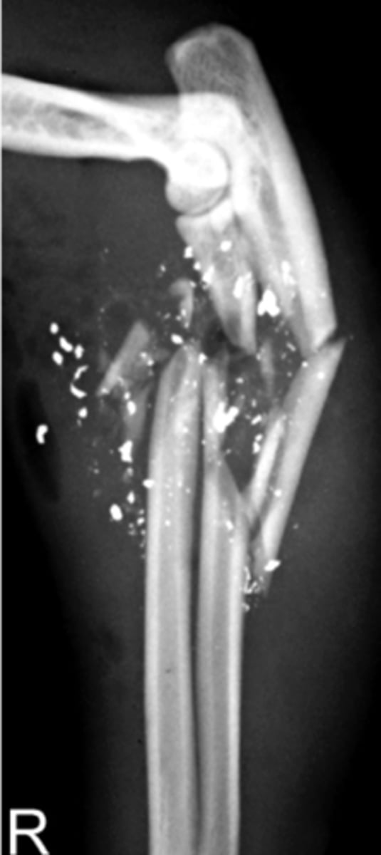 <p>Identify the fracture type?</p>