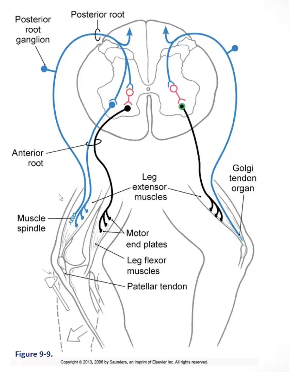 <p><strong><u>monosynaptic stretch reflex:</u></strong> <strong><u>sensory response to muscle stretch</u></strong> (aka: muscle stretch (MS) reflex; <strong><u>deep tendon reflex</u></strong>)</p><ul><li><p><strong><u>circuit:</u></strong> afferent limb: MS (muscle spindle) afferents; efferent limb: alpha-motor neurons</p><ul><li><p><u>muscle spindle afferents</u></p><ul><li><p>form monosynaptic excitatory connections with alpha-motor neurons in the ventral horn of the SC</p></li><li><p>these motor neurons innervate the same muscle that was stretched (<em>feedforward </em><strong><em>excitation)</em>= contraction of the agonist</strong></p></li></ul></li><li><p><u>reciprocal inhibition:</u></p><ul><li><p>via local circuit interneurons</p></li><li><p>inhibitory connections (<em>feedforward</em><strong><em> inhibition</em></strong><em>)</em> are made with the alpha-motor neuron of the antagonist muscle= <strong>relaxation of the antagonist</strong></p></li></ul></li></ul></li><li><p><strong><u>function:</u> </strong>plays a major role in the maintenance of posture and ensures coordination of agonist and antagonist muscle activity in response to changing conditions; it is also an important reflex to be tested to determine neurological damage</p><ul><li><p>e.g. muscles in the leg and torso are being stretched, activating reflex arc to counter the effects of the sway you experience while being on the subway</p></li></ul></li></ul><p><strong><u>image (left side)</u></strong></p><ul><li><p>sensory information comes in on the afferent limb (muscle spindle)</p></li><li><p>^ information will feed-forward excitation and excite the alpha motor neuron of the same muscle, causing it to contract</p></li><li><p>^ information will also feed-forward inhibition; an inhibitory interneuron will be excited and inhibit the alpha motor neuron of the antagonist muscle</p><ul><li><p>the agonist will contract</p></li><li><p>the antagonist, through reciprocal inhibition, will relax</p></li></ul></li><li><p>e.g. hammering your patellar tendon</p><ul><li><p>causes a stretch in your quadriceps muscle</p></li><li><p>causes muscle spindle to discharge and fire an AP</p></li><li><p>causes activation of the alpha motor neuron</p></li><li><p>causes quadriceps to contract (—&gt; extension of the knee)</p></li><li><p>and through reciprocal inhibition causes hamstrings to relax</p></li></ul></li></ul><p></p>