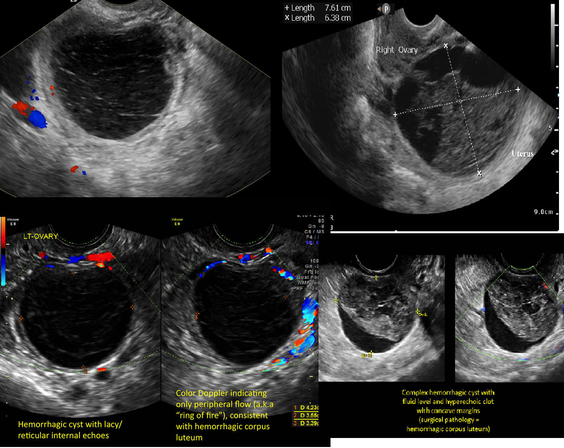 <ul><li><p>sudden pelvic pain</p></li><li><p>causes internal bleeding into a follicular cyst or corpus luteum cyst</p><p></p></li></ul><ul><li><p><span>Hours/days after:</span></p><ul><li><p><span> highly echogenic due to clot formation</span><br></p></li></ul></li></ul><ul><li><p><span>Several days after</span></p><ul><li><p><span> increasingly complex appearance</span></p></li></ul></li></ul><p></p>