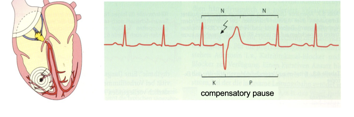 Premature depolarization occurs in the ventricles & can cause a delay in the normal electrical signal reaching the ventricles.
This can lead to a wide QRS complex on the ECG.
