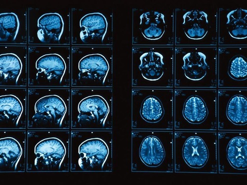 <ul><li><p>MRI scanners use strong magnetic fields and radio waves to form images of the body</p></li><li><p>Person lies in magnetic field and is exposed to particular radio frequency pulse, causes body to emit a signal</p></li><li><p>Creates 3D images that can be divided into slices, enlarged</p></li></ul>