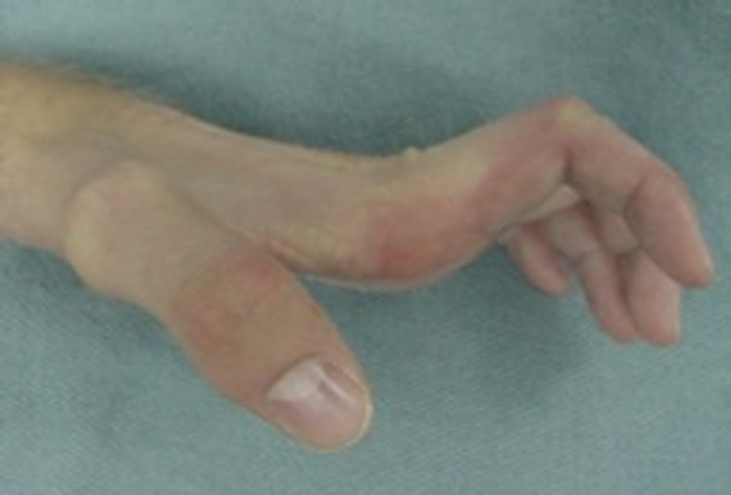 <p>weakness and atrophy of the hand intrinsic muscles result in extension of the MCP joint and flexion of the PIP and DIP joints. ulnar and median nerve pathology</p>