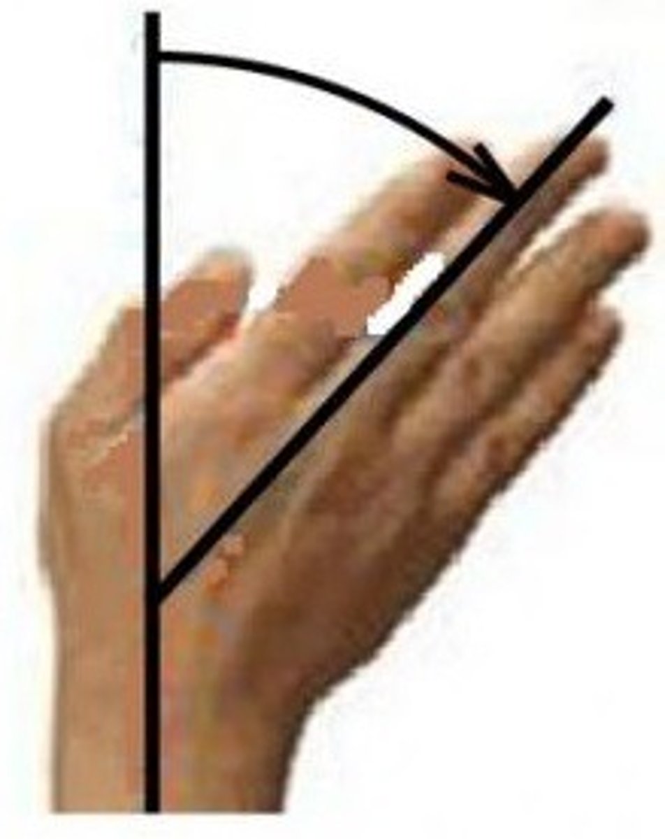 <p>ulnar deviation</p>