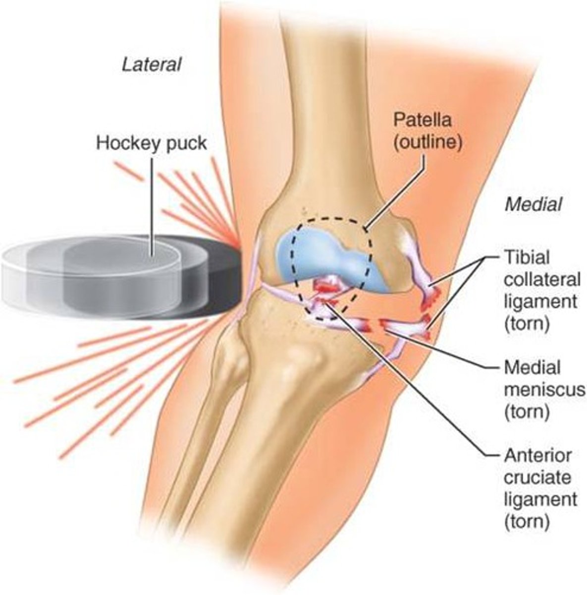 <p>Direct blow to the lateral aspect of the knee or twisting injury</p><p>Assessed by a valgus test </p>
