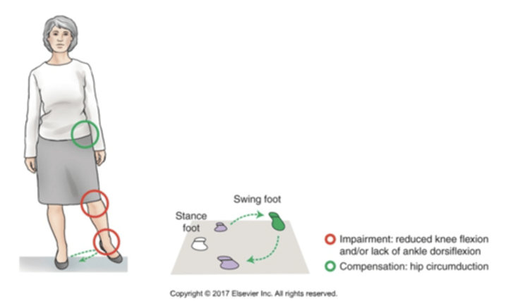 <p>•Hip Circumduction During Swing Due to Inadequate Hip, Knee Flexion, Ankle Dorsiflexion<br><br>•Swinging leg out to the side compensates for inability to shorten the swing leg<br><br>•Elevating the pelvis (hip hiking) is a similar compensation</p>