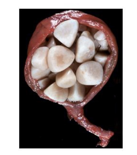 <p>what type of calculi is this?</p>