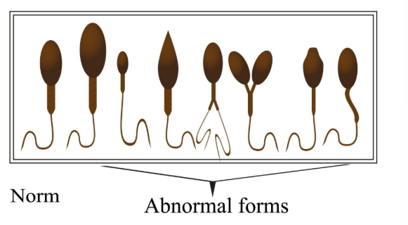 <ul><li><p>abnormal shape</p></li><li><p>low count</p></li><li><p>reduced fertilization rate</p></li><li><p>IVF</p></li></ul><p></p><p>This can</p><ul><li><p>impact ability to swim and fertilize</p></li><li><p>head defects </p></li><li><p>neck defects</p></li><li><p>tail defects</p></li></ul><p></p>