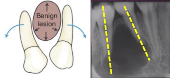 <p>benign, slower-growing, space-occupying lesions </p>
