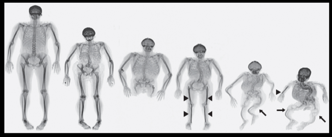 <p>Osteogenesis imperfecta</p><p>-autosomal dominant. has 100% penetrance</p><p>-failure to make functional collagen</p><p>-manifested in differing degrees</p>