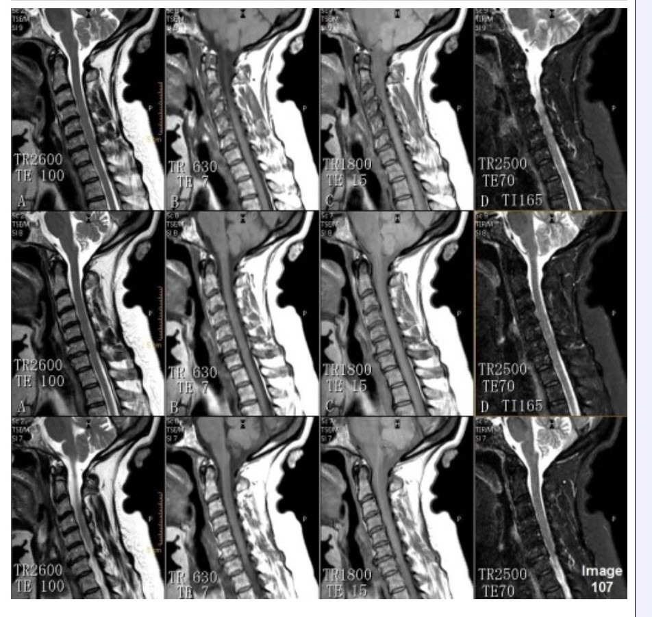 <p><span>&nbsp;Column C in Image 107 corresponds to which MRI pulse sequence?</span></p><p><span>&nbsp;A. Proton density</span></p><p><span>&nbsp;B. T1 weighted</span></p><p><span>&nbsp;C. T2 weighted</span></p><p><span>&nbsp;D. T2 FLAIR</span></p><p><span>&nbsp;E. STIR</span></p>