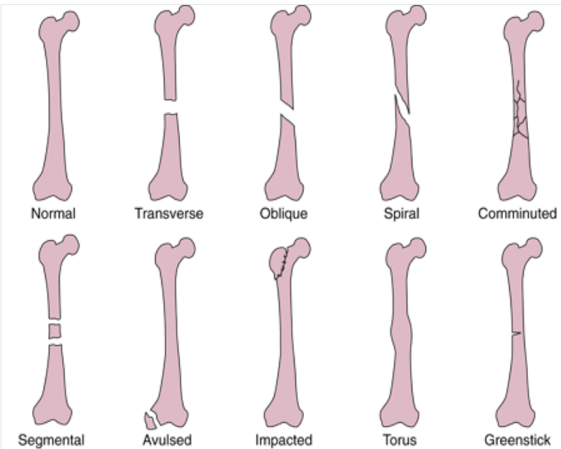 <p>Fracture types</p>